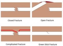 Open fracture, closed fracture, complicated fracture, green stick fracture Open fracture, closed fracture, complicated fracture, green stick fracture