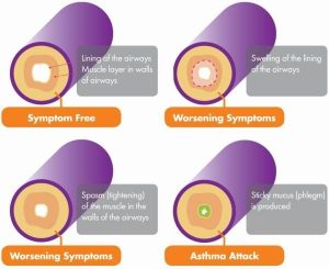 Effects of Asthma on airways